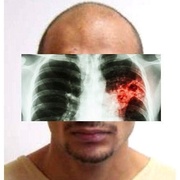 Pátrání po roznašeči TBC ukončeno! Informace pro osoby, které se s ním setkaly: