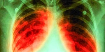 Ubytovny a montovny - hrozba TBC