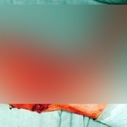 Utržená ruka v zápěstí i odervané prsty