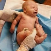 Boj o život miminka v inkubátoru