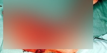 Utržená ruka v zápěstí i odervané prsty