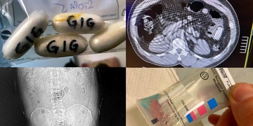 Střeva nigerijského polykače skrývala 55 kontejnerků s kokainem