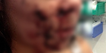 Přepadená žena s rozsekanou hlavou na Lochotíně